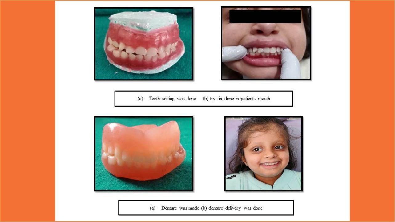 TMU’s Department of Pediatric and Preventive Dentistry Treated a Case of Hypohidrotic Ectodermal Dysplasia